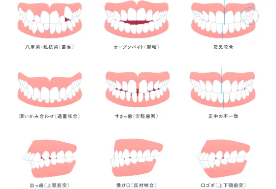 ほとんどの噛み合わせに対応できる