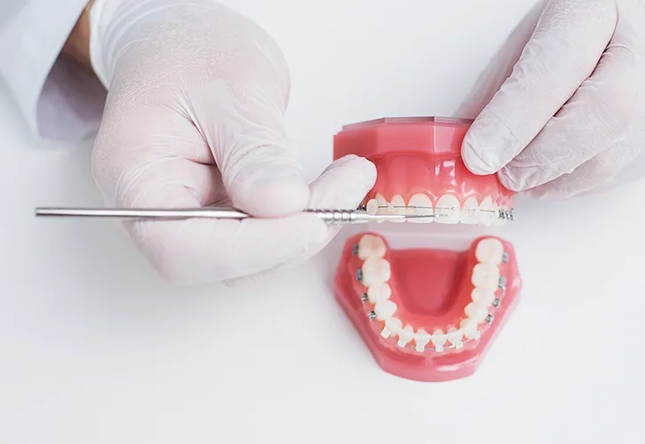 矯正装置の装着