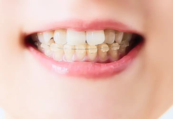 ハーフリンガルとは