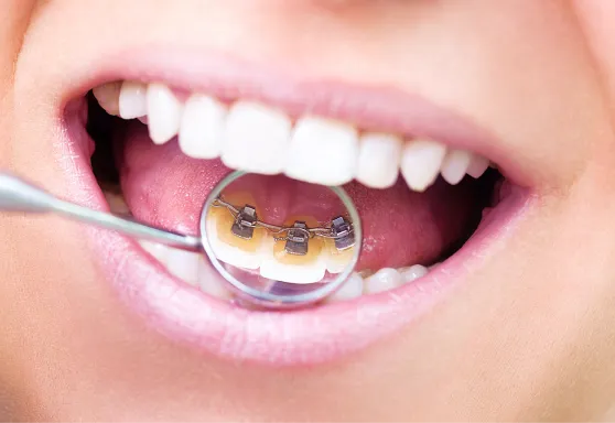 舌側矯正への専門的な取り組み