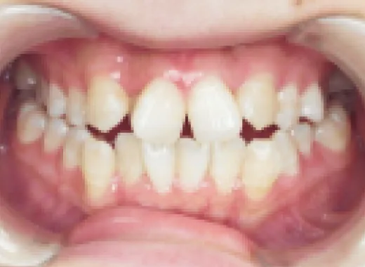 矯正治療の症例Before