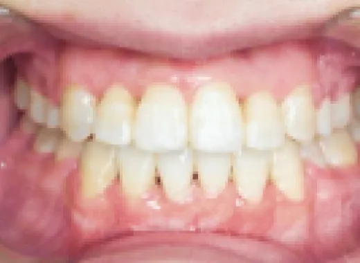 矯正治療の症例After