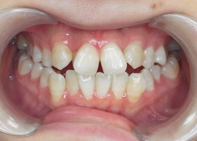 前歯のでこぼこを治したい｜24歳女性