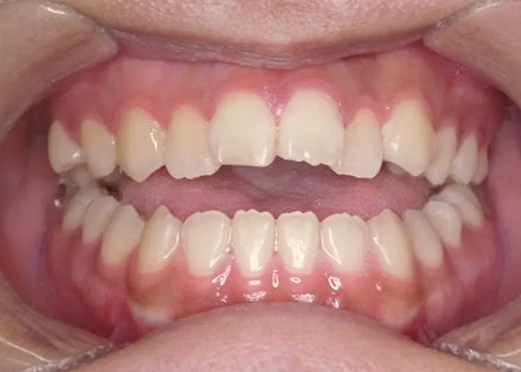 開咬、前歯でごはんを食べたい｜18歳女性