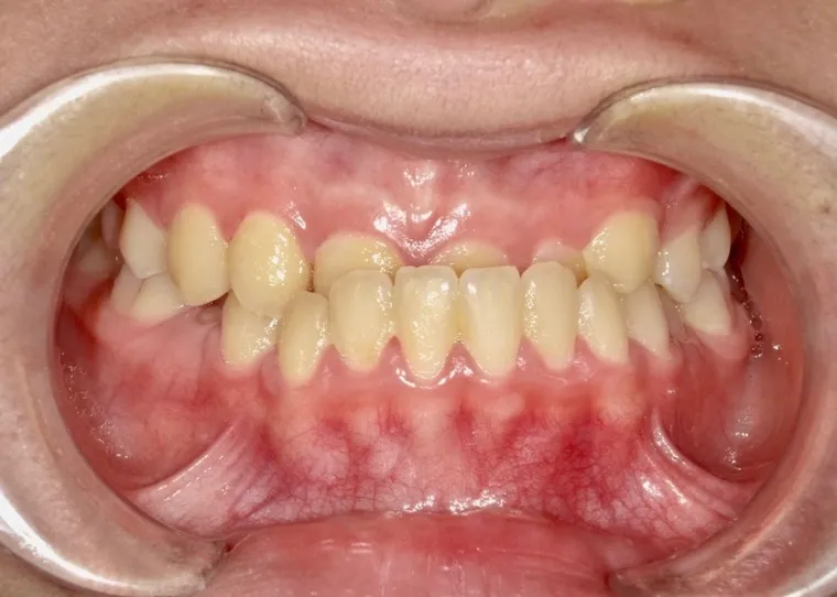 受け口｜11歳男性