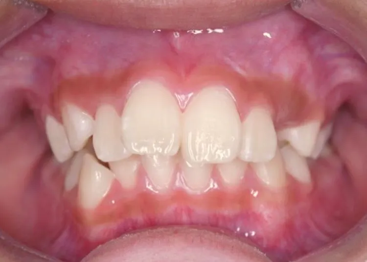 出っ歯、でこぼこを治療したい｜9歳女性